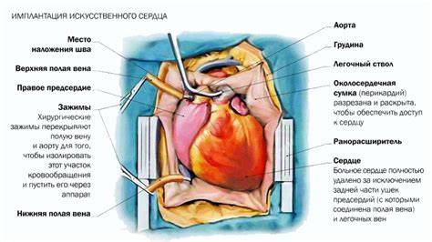Хирургия сердца | Meddoc