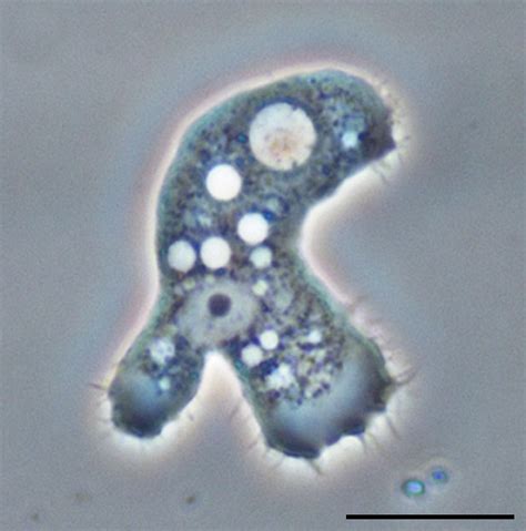 What Is Acanthamoeba Infection? - StoryMD