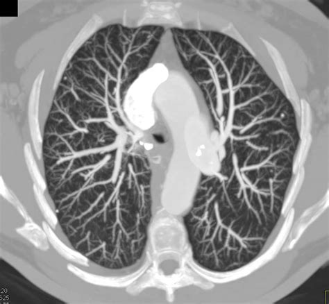 Multiple Bilateral Pulmonary Arteriovenous Malformations PAVMs In A