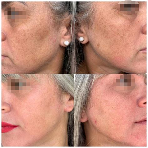 Suavicid Antes E Depois Melasma Manchas E Espinhas