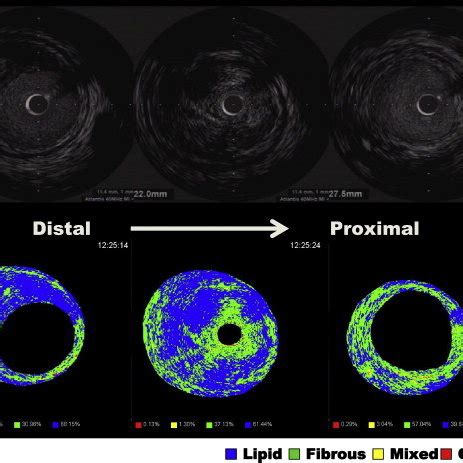 Conventional IVUS (upper panels) and IB-IVUS images (lower panels). The ...