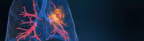 Neueinf Hrung Rybrevant Bei Nichtkleinzelligem Lungenkrebs Nsclc