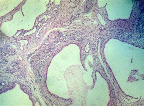 Histology of a teratoma showing multiple immature elements in it ...