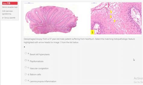 Gi Pathology Flashcards Quizlet