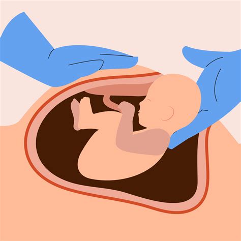 Illustration Of C Section Or Cesarean Process Vector Art At