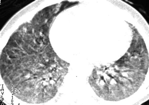 Eosinophilic Lung Diseases A Clinical Radiologic And Pathologic