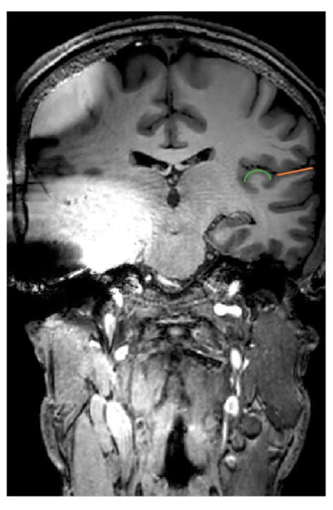 Jcm Free Full Text Research Insights On Neural Effects Of Auditory Deprivation And