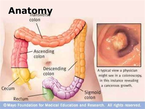 Colonoscopy With Polypectomy