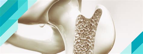 What is Osteoporosis (Bone Resorption)? Symptoms and Treatment