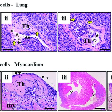 Thrombosis Caused By Kaiso Positive Tumors Invading The Blood Vessels