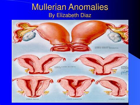 Ppt Mullerian Anomalies By Elizabeth Diaz Powerpoint Presentation