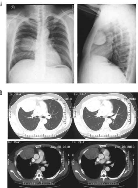 Chest Images A Chest Radiograph A Mass Is Seen In The Right Middle