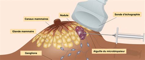 La Micro Biopsie Mammaire Radiologie Bordeaux