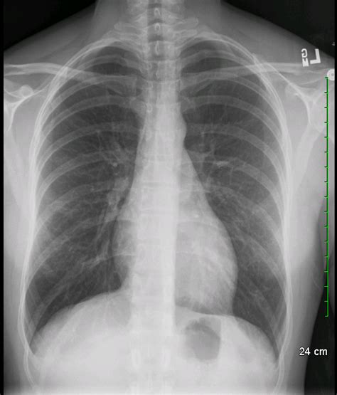 Lateral View Chest X Ray Anatomy