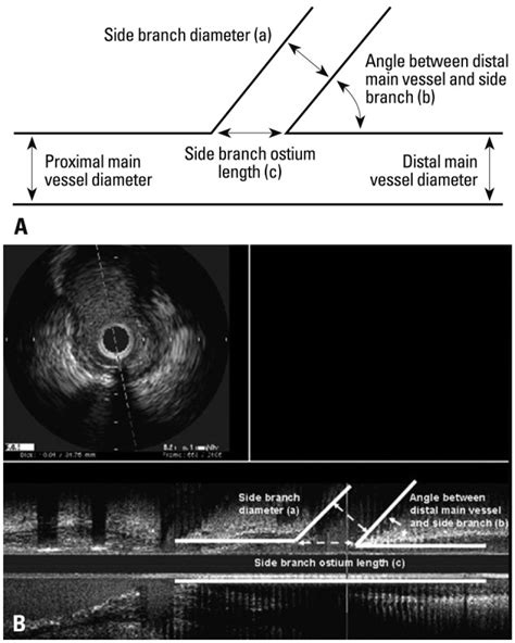 Intravascular Ultrasound IVUS Measurements In This Study Are Shown In