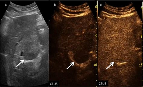 Ceus Li Rads A Pictorial Review Abstract Europe Pmc