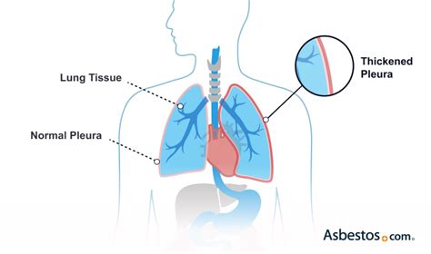 Pleural Thickening And Asbestos Causes Symptoms And Treatment