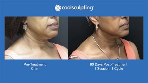 Coolsculpting | Body Sculpting | Near Me | Bel Air MD | Harford County ...