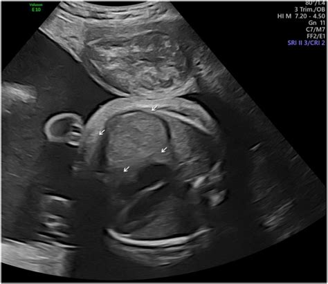 Case Report Of Congenital Myotonic Dystrophy With Multiple Prenatal