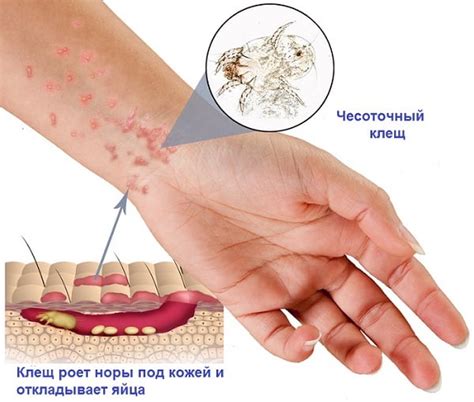 Чесотка: симптомы, фото, лечение. Как лечить чесотку