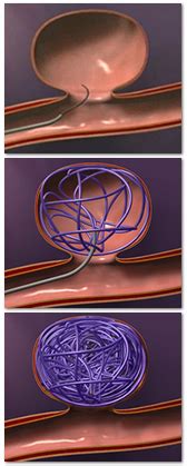 Storm Anesthesia - Endovascular Embolization or Coiling