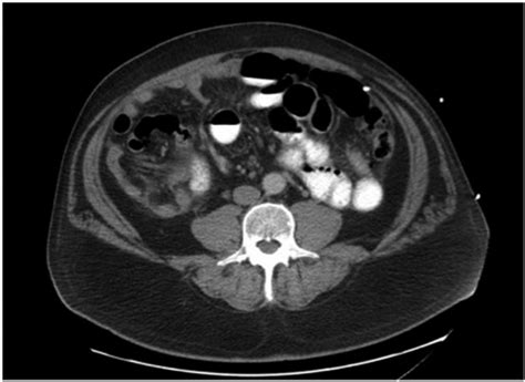 The Initial Computed Tomography Scan Of The Abdomen And Pelvis Showed