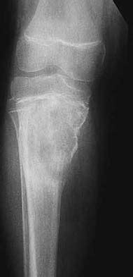 Osteosarcoma Codmans Triangle