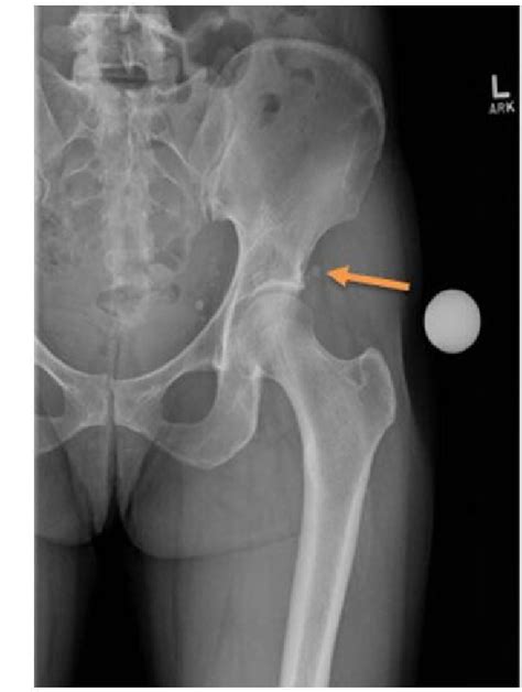 Figure 1 From Rare Case Of Symptomatic Calcific Tendinopathy Of The Origin Of Rectus Femoris