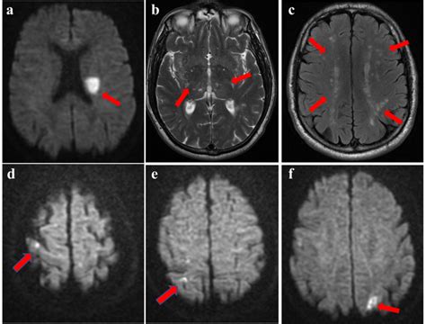 Patient 2. a-c Brain MRI performed after the first stroke. a MRI DWI ...