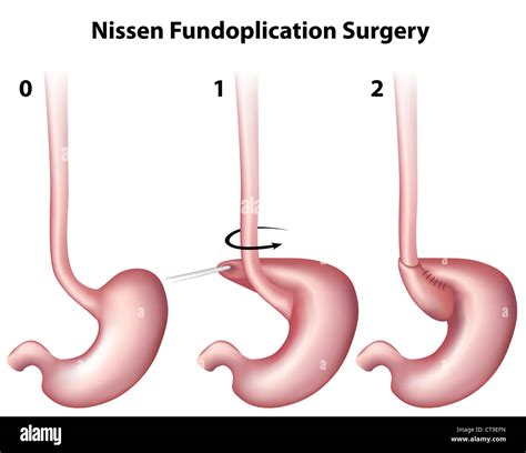 Nissen Fundoplication Surgery Stock Photo Alamy