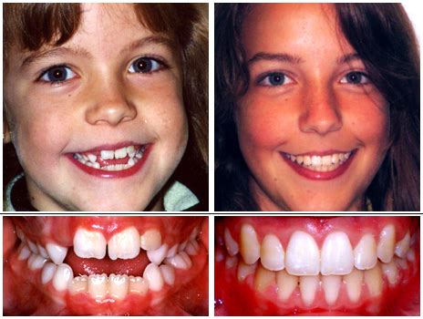 Before and After - dk orthodontics | Caldwell Parsippany NJ