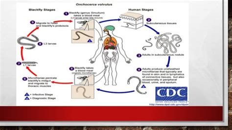 Onchocerciasis