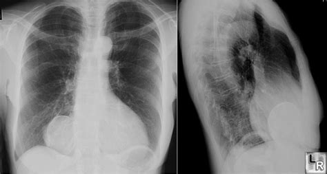 Learning Radiology - Pericardial Cyst