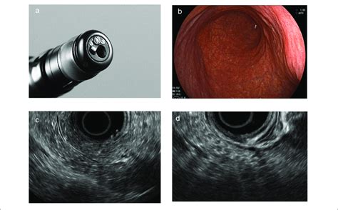 Direct Forward Viewing Radial Endoscopic Ultrasound FR EUS A The