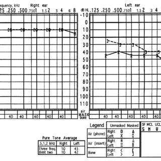 Pure Tone Audiogram Revealed An Improvement With Pure Tone Threshold 25