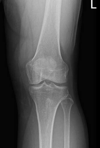 Case Study Knee Arthroscopy Medial And Lateral Meniscectomy Cyclops