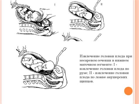 Кесарево сечение - online presentation