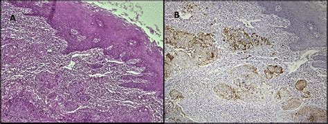 58 Year Old Male Patient With Moderately Differentiated Oropharyngeal Download Scientific