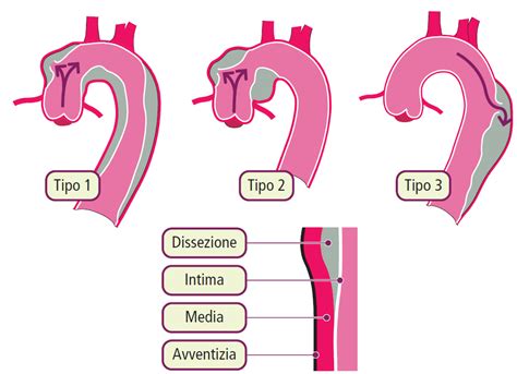 La Dissecazione Aortica Bald Mountain Science