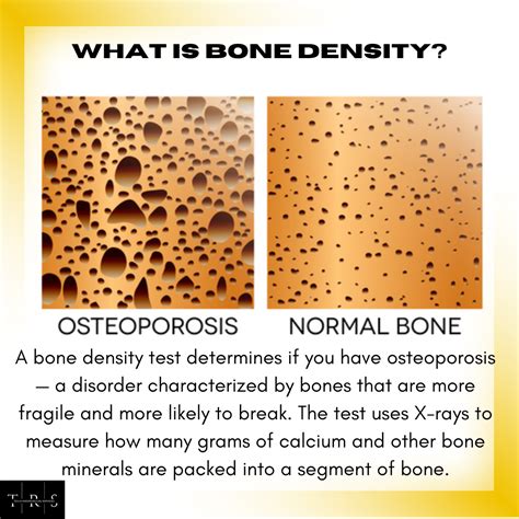 What Is Bone Density Tesla Radiological Services