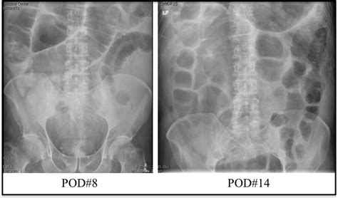 Select Abdominal Plain Films Representing Continued Diffuse Dilation Of