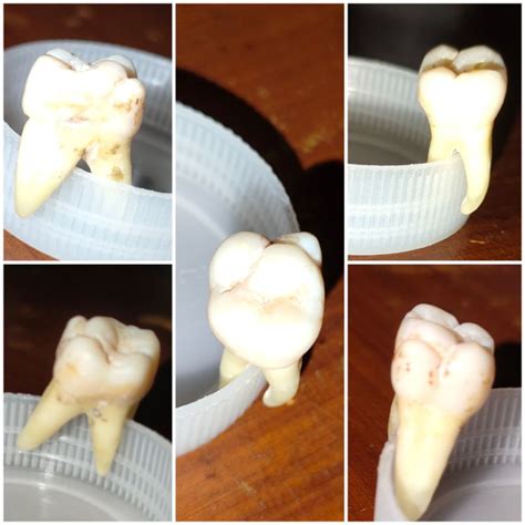 Jual Gigi Praktikum Kedokteran Gigi Molar Atas Free Caries Perfect