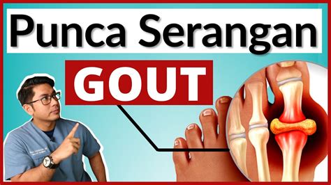 Makanan Punca Serangan Gout Uric Acid Tinggi Doctor Sani Youtube