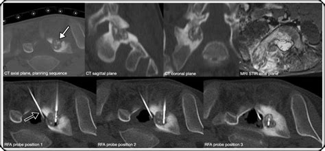 Spinal Rfa Of An Osteoblastoma White Arrow In The First Sacral