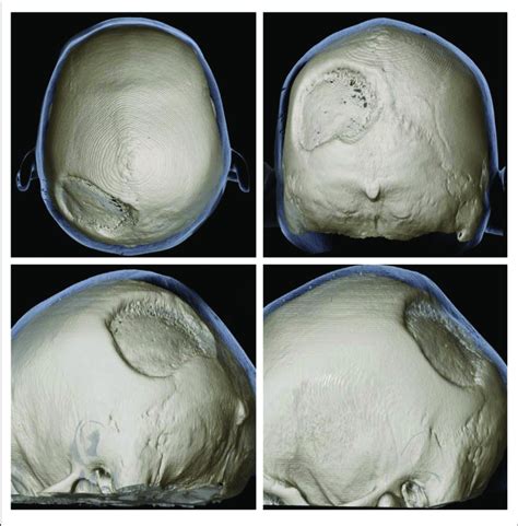 3D Reconstruction Of Skull CT From Multiple Angles Showing The