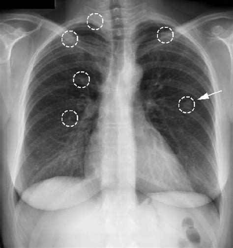 Figure 10 From Neural Networks For Computer Aided Diagnosis Detection Of Lung Nodules In Chest