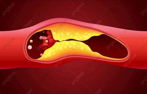 Gambar Ilustrasi Sel Darah Merah Dan Kolesterol Menyumbat Penyebab