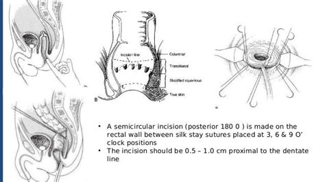 Hirschsprung Disease Approach And Management