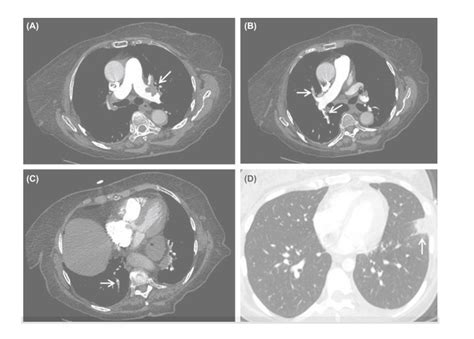 Pulmonary Embolism Detection