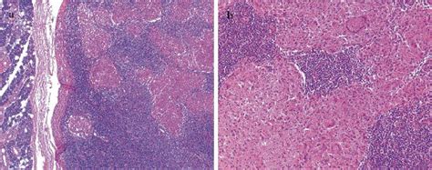 Primary Parotid Tuberculosis Mimicking Parotid Neoplasm A Case Report